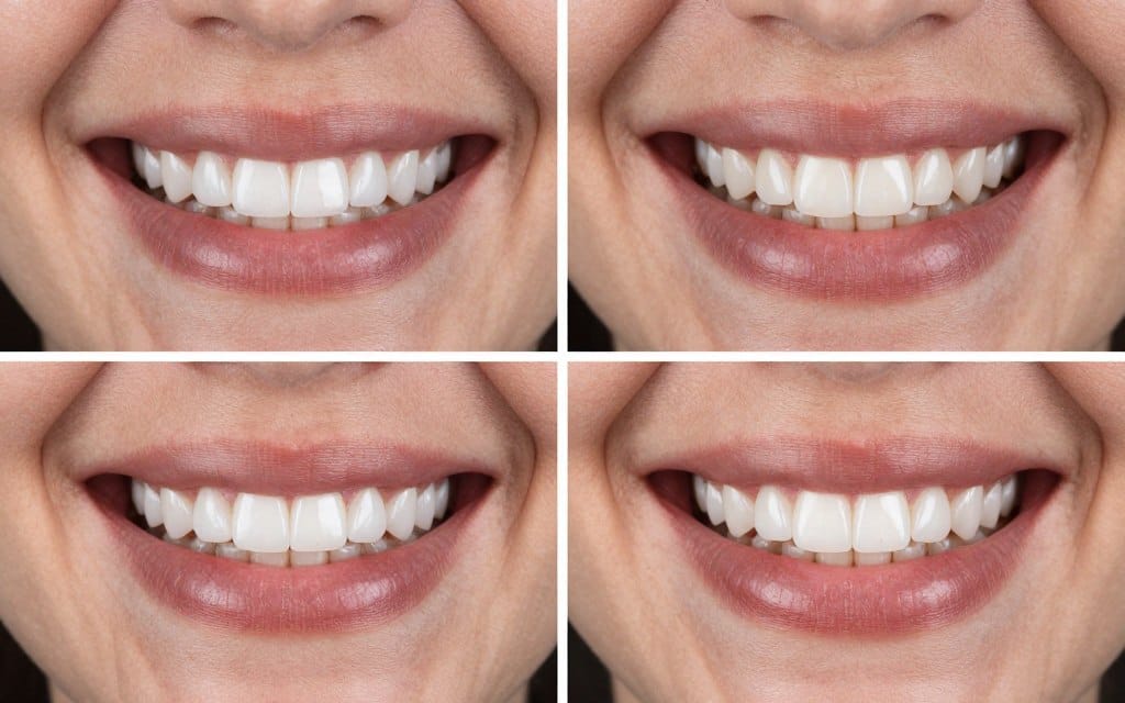 Before and after smile transformation showing cosmetic dentistry results Before and after smile transformation showing cosmetic dentistry results