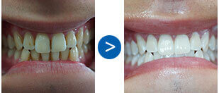 mysmiledoctor teeth3
