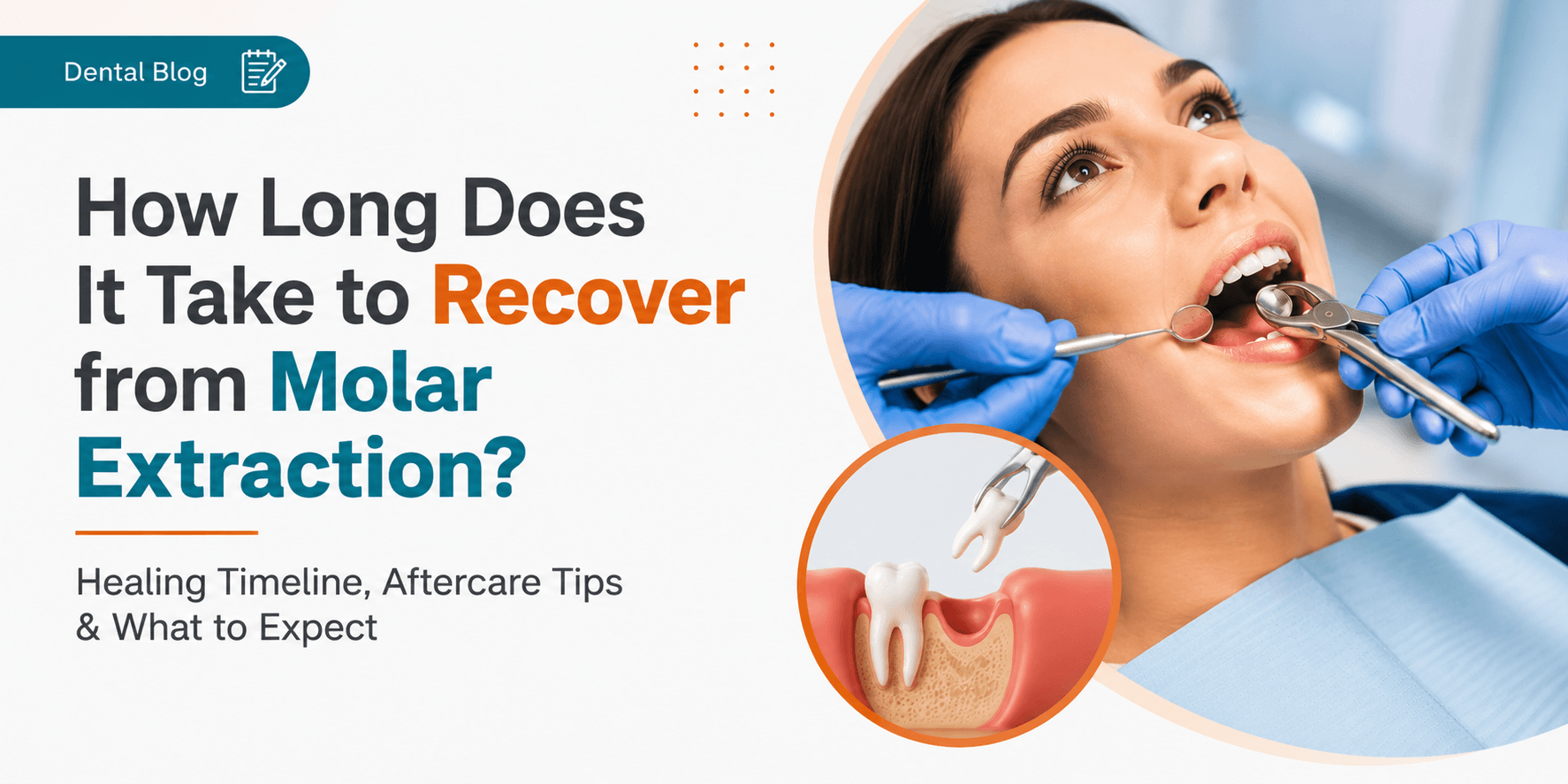 How Long Does It Take to Recover from Molar Extraction?